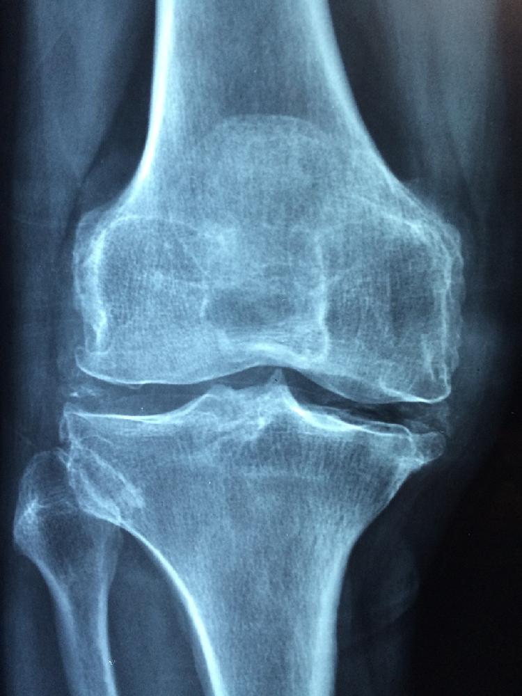 Leczenie bólu kolana laserem zimnym